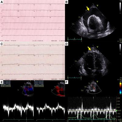 Case report: Successful treatment of malignant pericardial effusion with pericardiocentesis, concurrent anti-inflammatory therapy and cancer therapy